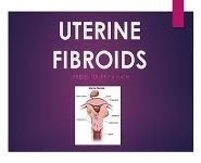 Uterine Fibroids PowerPoint Presentation