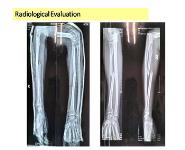 Galeazzi Fracture PowerPoint Presentation