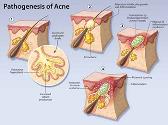 Acne Disease