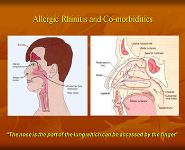 Allergic Rhinitis and co-morbidities in children PowerPoint Presentation Notes