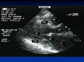 Mitra Valvular Disease