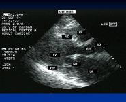 Mitra Valvular Disease PowerPoint Presentation