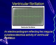Arrhythmia PowerPoint Presentation
