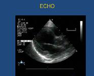 Arrhythmia in Babies and Children PowerPoint Presentation