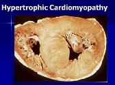 Cardiomyopathy
