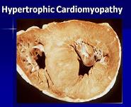 Cardiomyopathy PowerPoint Presentation