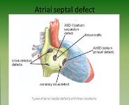 Congenital Heart Diseases PowerPoint Presentation