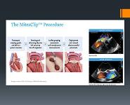 Mitral Valve-To Clip or Not to Clip PowerPoint Presentation