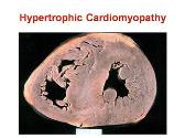 Hypertrophic Cardiomyopathy 