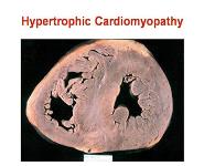 Hypertrophic Cardiomyopathy  PowerPoint Presentation