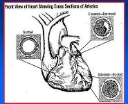 Arteriosclerosis and Coronary Heart Disease-CHD PowerPoint Presentation Notes