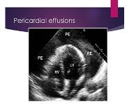Select disorders of the Pericardium and Myocardium  PowerPoint Presentation
