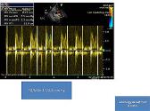 Echocardiographic Evaluation of Prosthetic Cardiac Valves 