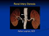 Renal Artery Stenosis 