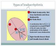 Arrhythmias  PowerPoint Presentation