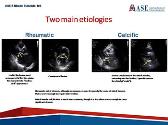 Acquired Mitral Stenosis in the Adult