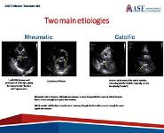 Acquired Mitral Stenosis in the Adult PowerPoint Presentation