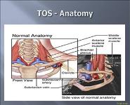 Thoracic Outlet Syndrome  PowerPoint Presentation