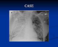 Lung Transplant  PowerPoint Presentation