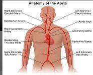 Nursing Care Plan of Aortic Aneurysm  PowerPoint Presentation