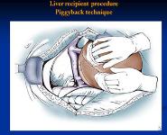 Liver & GI Transplanation  PowerPoint Presentation Notes