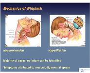Botulinum toxin use in post traumatic cervical dystonia and head tremor PowerPoint Presentation