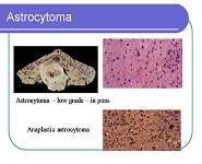 Brain Tumors PowerPoint Presentation