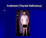 Mental Retardation PowerPoint Presentation