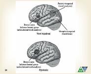 Gifted Students with Specific Learning Disabilities-Reading and Writing Disability PowerPoint Presentation