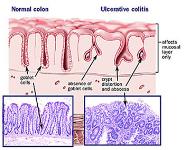 Inflammatory Bowel Diseases PowerPoint Presentation Notes