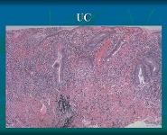 Inflammatory Bowel Disease PowerPoint Presentation Notes