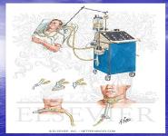 Mechanical Ventilation PowerPoint Presentation