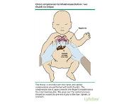 Neonatal resuscitation-NNR PowerPoint Presentation Notes