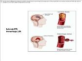 Ischemic Stroke