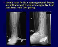 Acute Respiratory Distress Syndrome-Fat Embolism and Thromboembolic Disease PowerPoint Presentation Notes