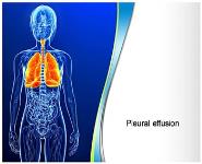 Pleural Effusion PowerPoint Presentation