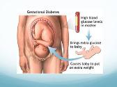 Gestational Diabetes Mellitus Stake