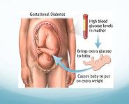 Gestational Diabetes Mellitus Stake PowerPoint Presentation Notes
