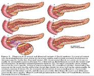 Acute Pancreatitis PowerPoint Presentation Notes