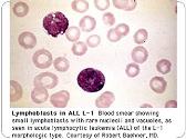 Acute Leukemia