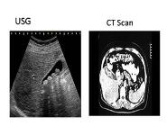 Gall Stone Disease-Etiology Clinical Features Diagnosis Complications PowerPoint Presentation Notes