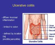 Drug Treatment Inflammatory Bowel Disease PowerPoint Presentation
