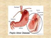Peptic Ulcer Disease