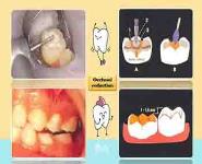 Conventional Technique of Stainless Steel Crown PowerPoint Presentation