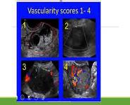 Malignant Ovarian Tumours PowerPoint Presentation
