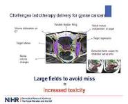 Radiotherapy Research in Gynaecological Cancers PowerPoint Presentation Notes