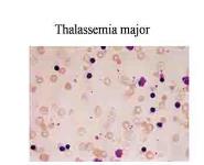 Hemolytic anemias-Hemoglobinopathies PowerPoint Presentation Notes