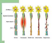 Peripheral Nerve Injuries PowerPoint Presentation Notes