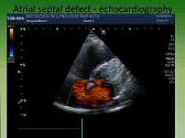 Congenital Heart Diseases