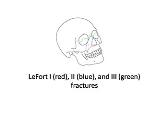 Le Fort fracture of skull